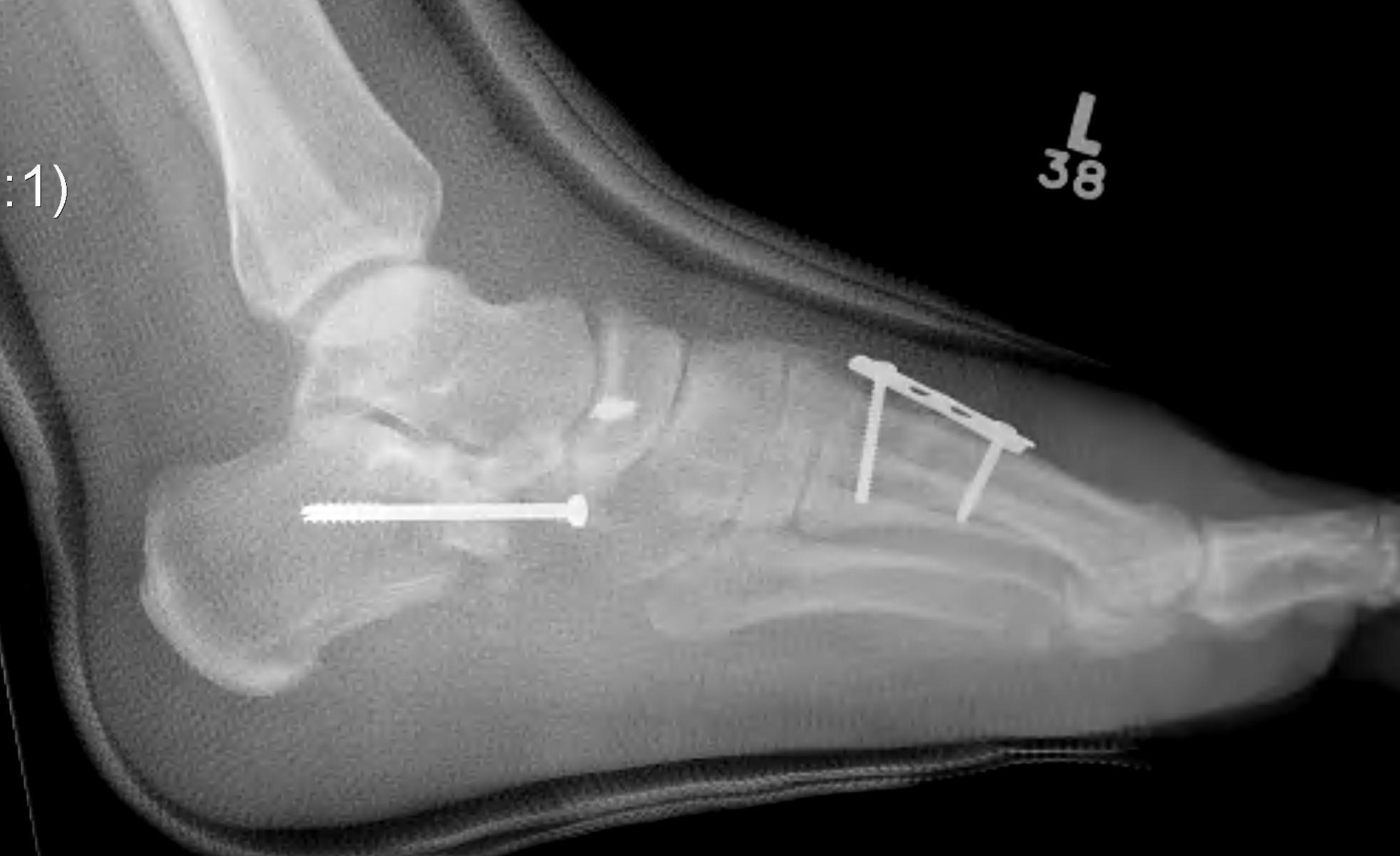 Evans Osteotomy + MT Osteotomy + FDL transfer